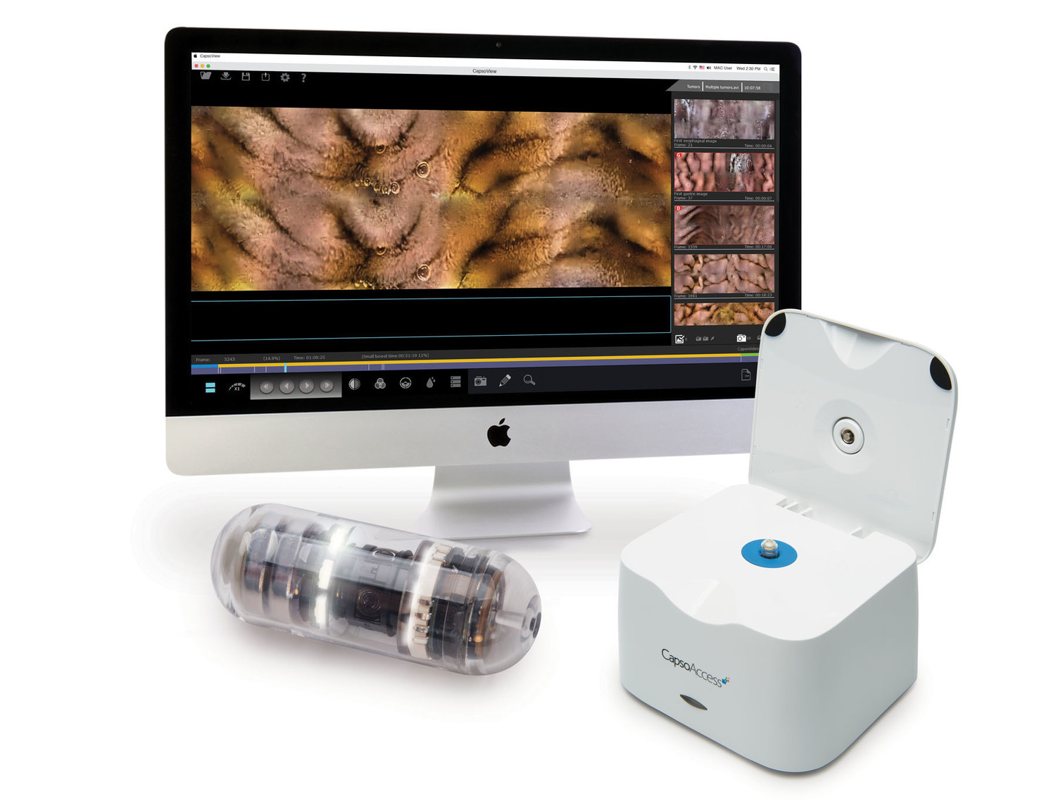 Видеокапсула эндоскопическая, капсульная эндоскопия, CapsoCam, PillCam, Capsovision, Корнеев Алексей Александрович, лучший врач, лучший центр, диагностика рака, рак кишки, рак желудка, полипы кишки, полипы желудка Видеокапсула эндоскопическая, капсульная эндоскопия, CapsoCam, PillCam, Capsovision, Корнеев Алексей Александрович, лучший врач, лучший центр, диагностика рака, рак кишки, рак желудка, полипы кишки, полипы желудка