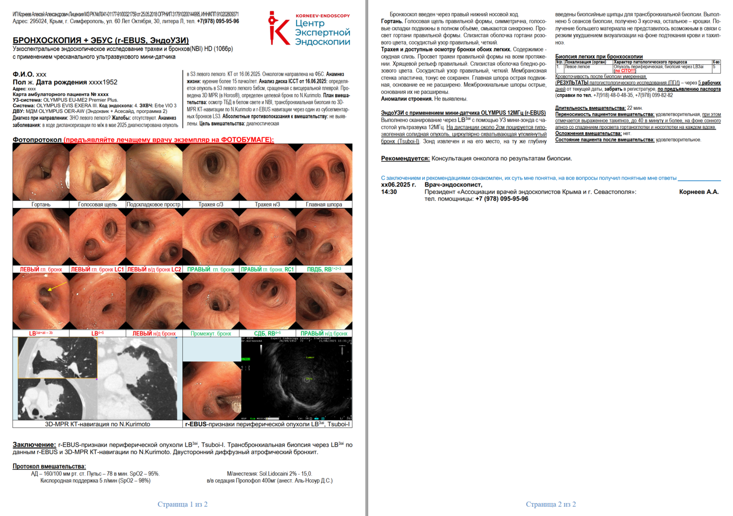 Бронхоскопия. ЭндоУЗИ. Рак лёгкого. Лучший Центр. ТББЛ. Биопсия лёгкого. Алексей Корнеев. Лучший. Фотопротокол топ-экспертной бронхоскопии у пациента раком лёгкого, с детальным описанием и полной фотодокументацией, с трансбронхиальной биопсией лёгкого (ТББЛ) с применением КТ-навигации по методике Kurimoto и УЗИ мини-датчика (r-EBUS). Корнеев Алексей Александрович - лучший врач эндоскопист